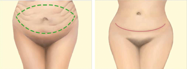 Animation einer Bauchdeckenstraffung 