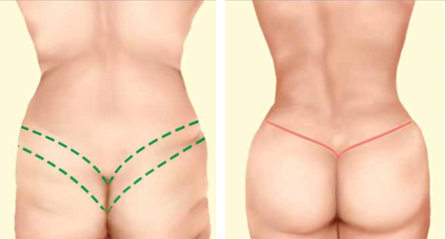 Animation eines unteren Body-Lifts