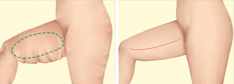 Animation einer Oberschenkelstraffung