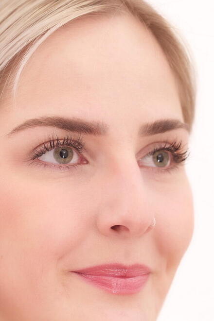 Ober-/ Unterlidstraffung (Blepharoplastik)