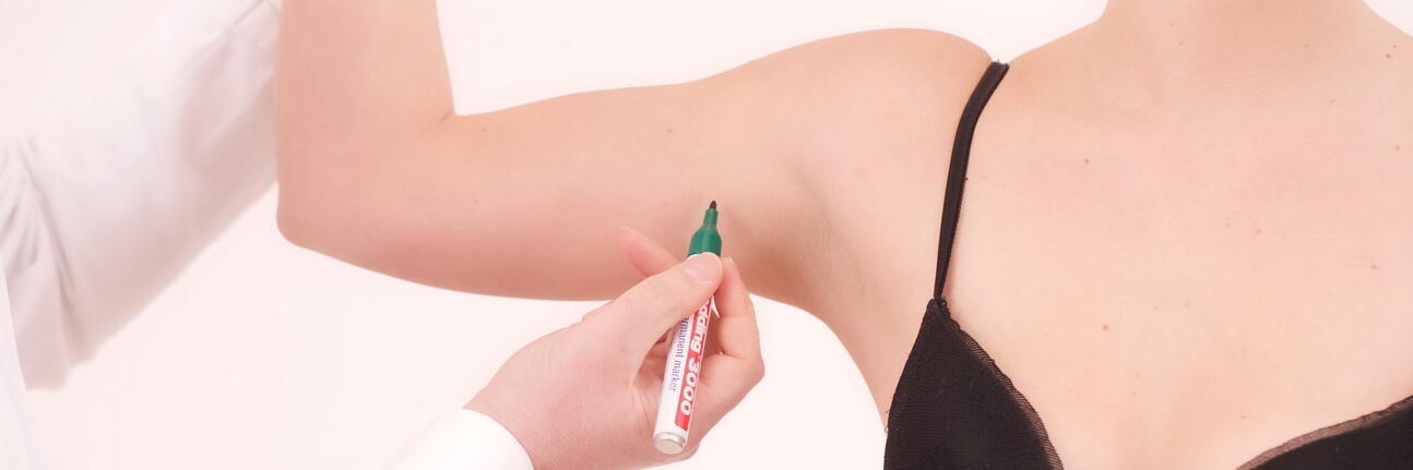 Einzeichnung der Markierungen einer Oberarmstraffung