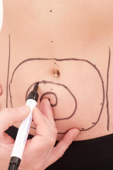 Einzeichnung von Kreisen auf Frauenbauch für CoolSculpting