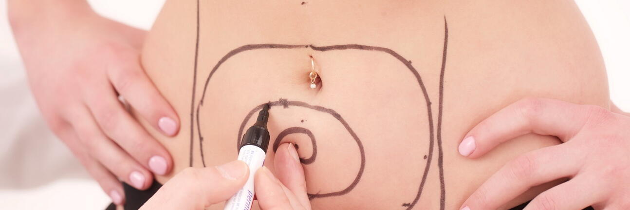 Einzeichnung von Kreisen auf Frauenbauch für CoolSculpting