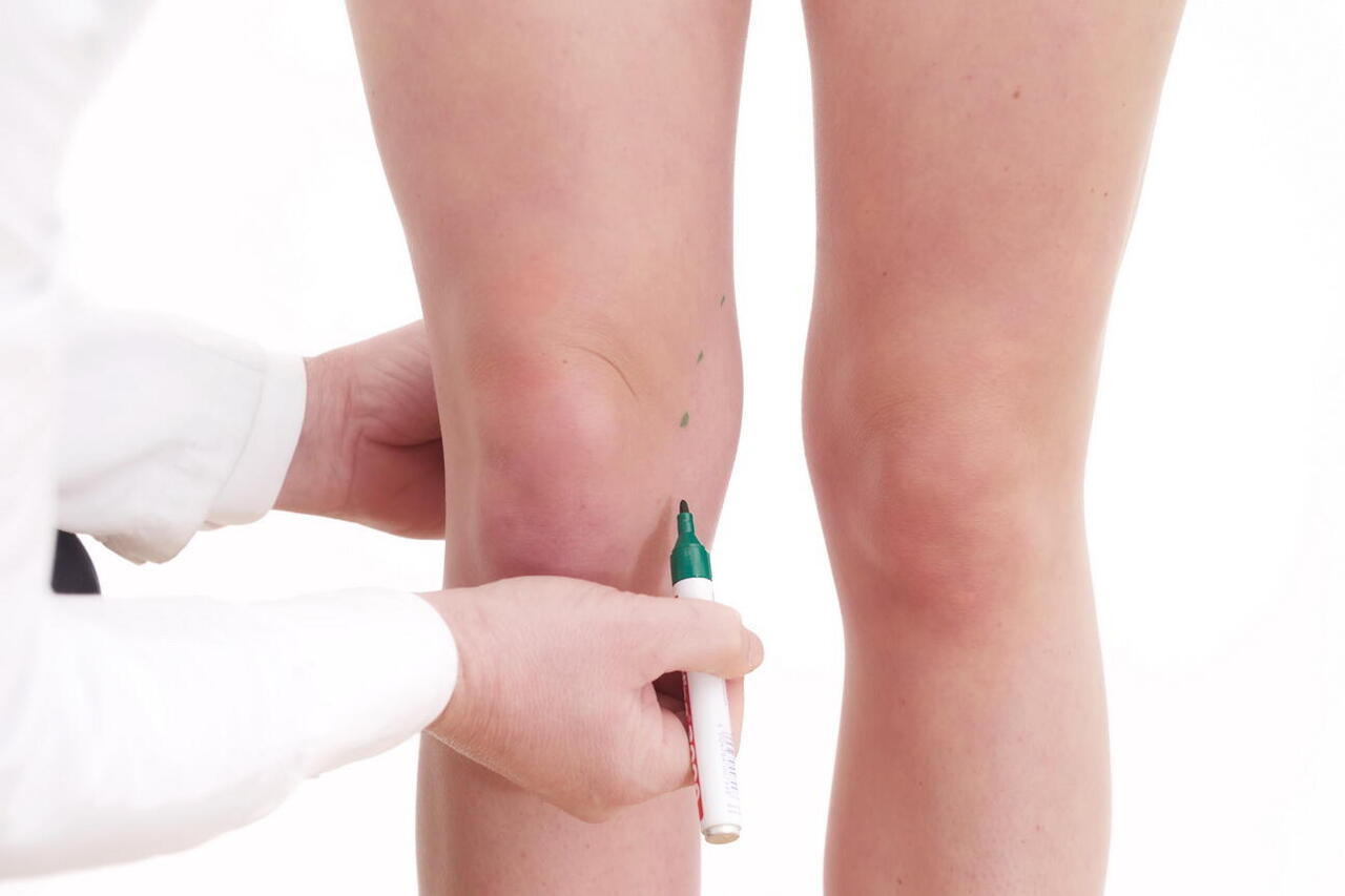 Einzeichnen ung von Punkten für einen Eingriff am Knie